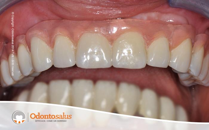 17Denti-sup-Chirurgia-ricostruttiva